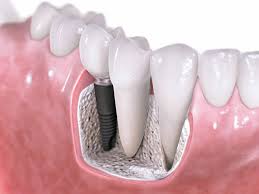 implantologia oral