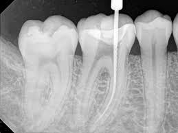 endodoncia